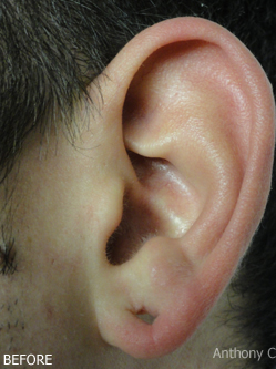 EarLobe repair nyc_before